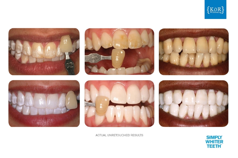KöR Teeth Whitening in Excelsior