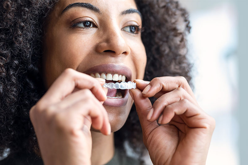 Clear Aligner Therapy in Excelsior