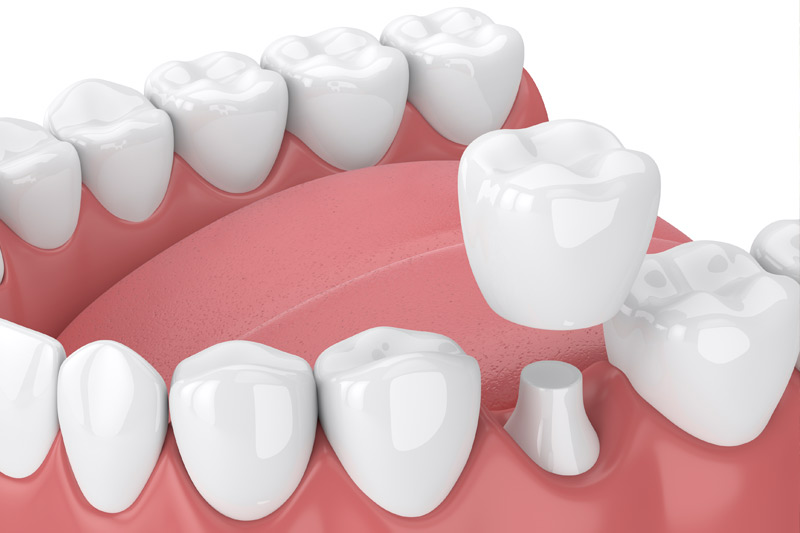 Dental Crowns in Excelsior