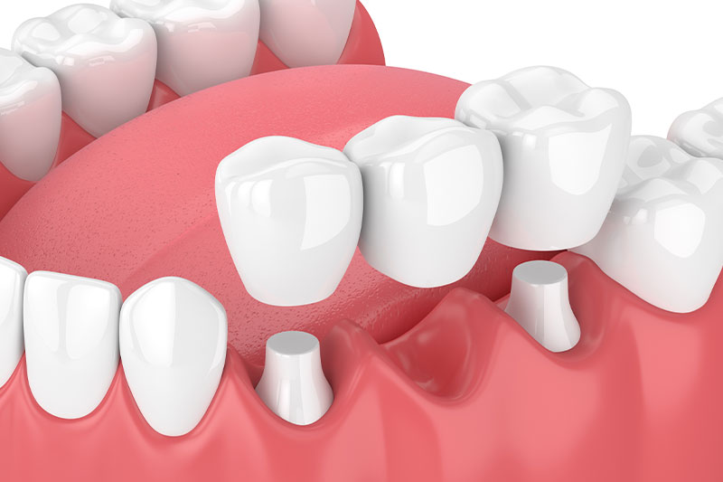 Dental Bridges in Excelsior