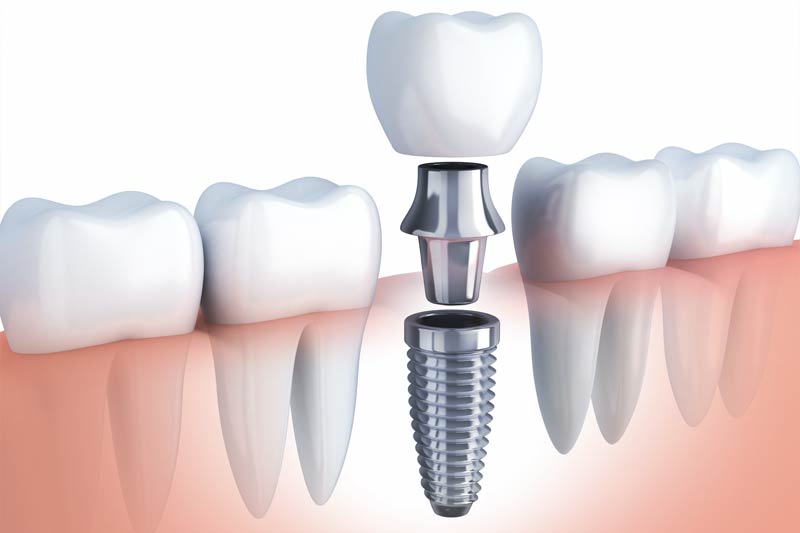 Implants Dentist in Excelsior