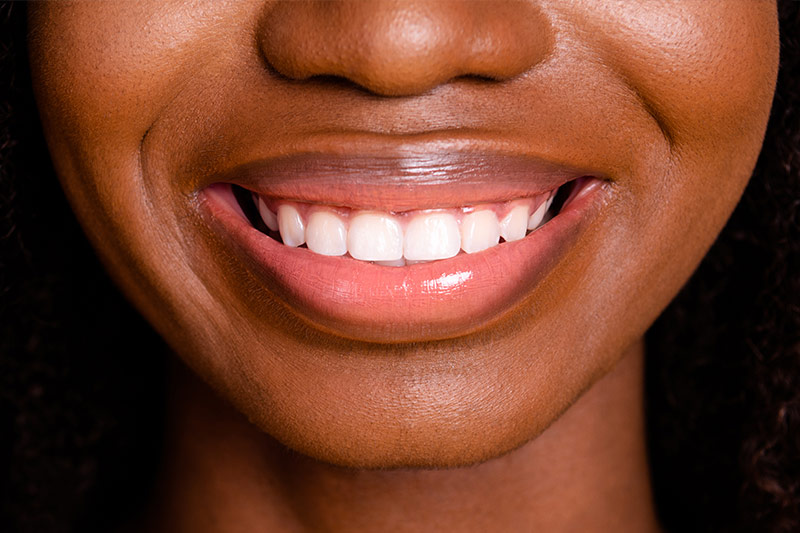 Gum Contouring in Excelsior