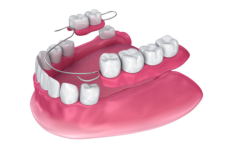 Partial Dentures in Excelsior