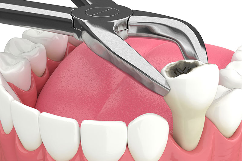 Tooth Extractions in Excelsior