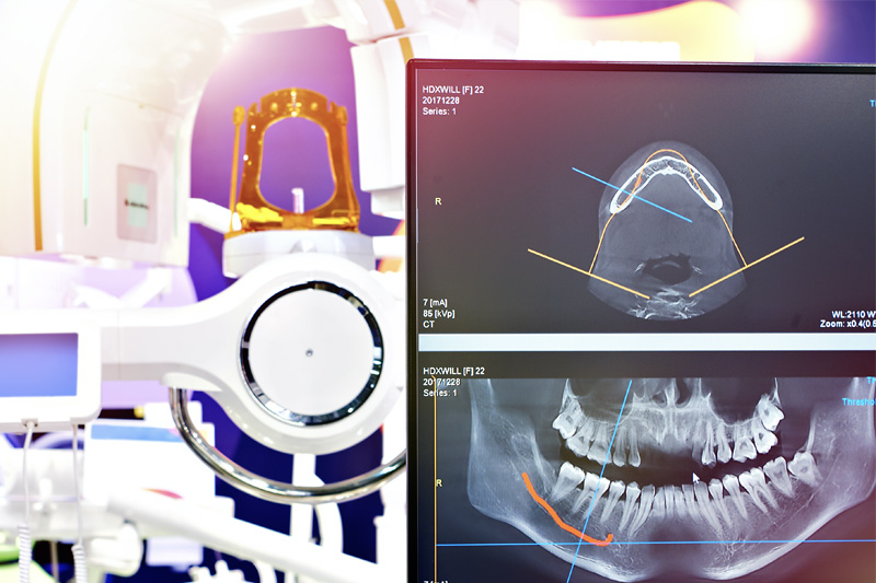 Digital X-Rays in Excelsior